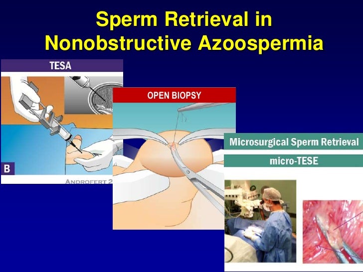 Throat fuck compilation video Sperm retrevial after prostatectomy